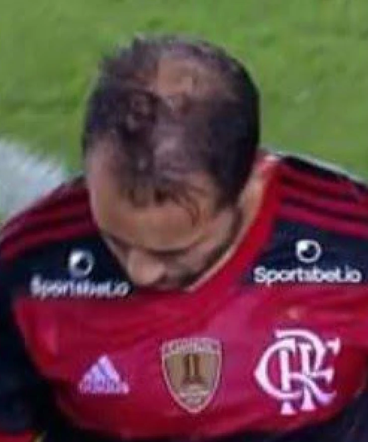 Everton Ribeiro em campo, com rarefação visível na frente e no topo da cabeça.