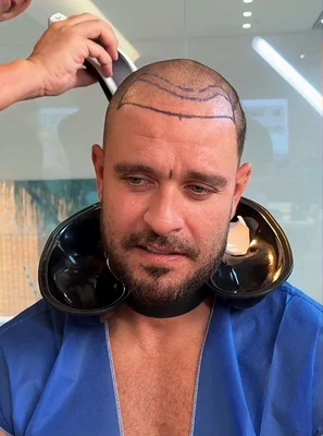 Diogo Nogueira durante raspagem do cabelo, com marcações visíveis na frente e no topo da cabeça.