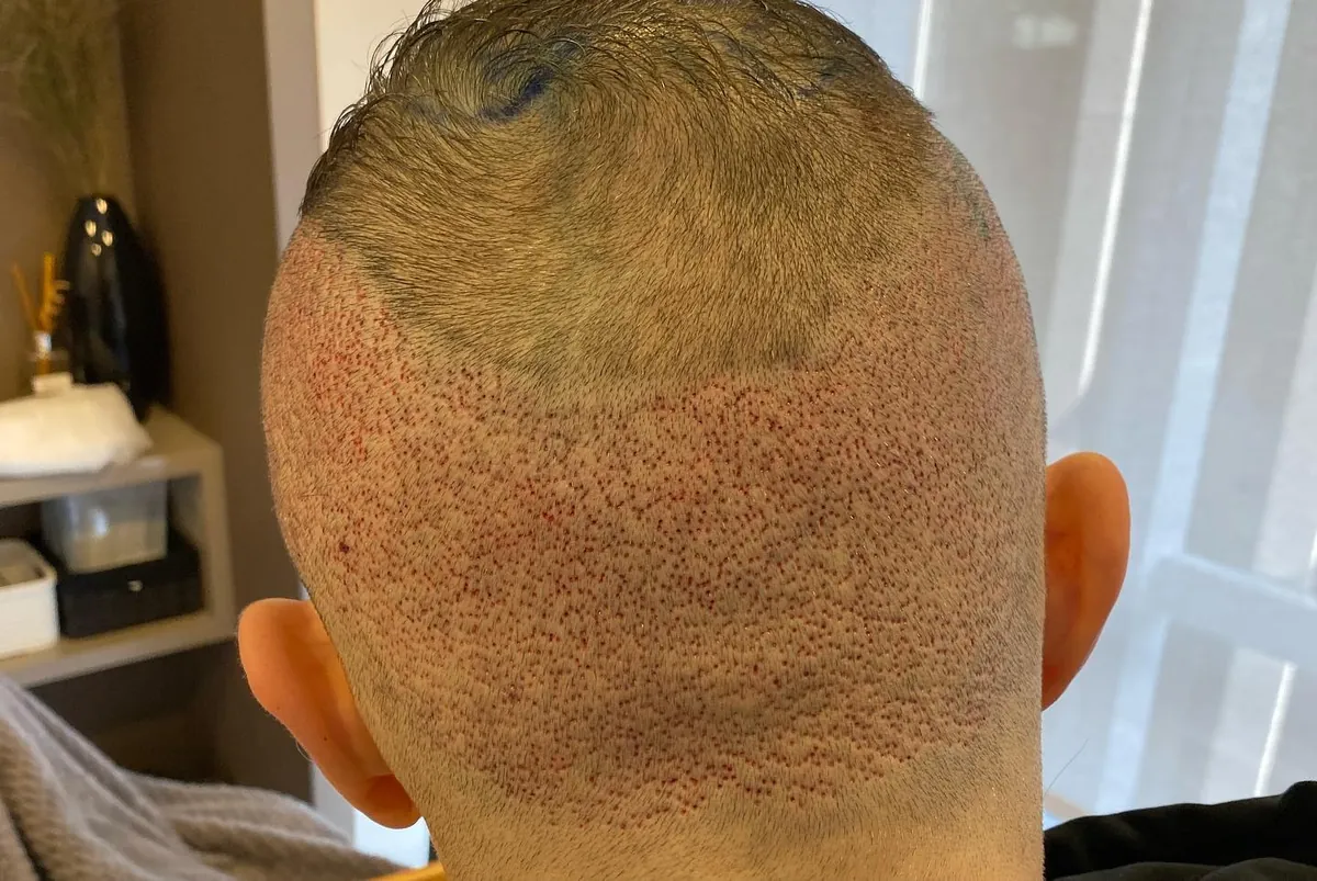 Vista posterior da cabeça de Lucas Lima, com área doadora raspada e pontos de extração dos folículos.