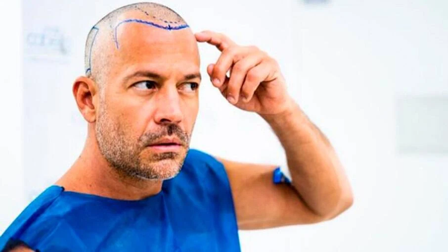Malvino Salvador com roupa clínica azul, cabeça raspada e marcações na linha frontal do cabelo.