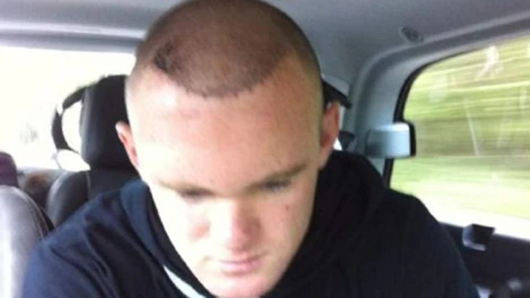Wayne Rooney dentro de um carro, com a cabeça inclinada e a região frontal raspada após o transplante.