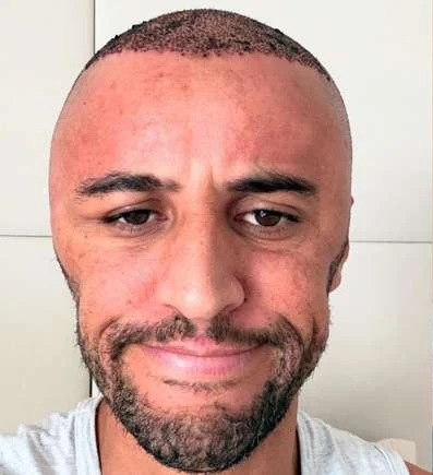 Wesley Alemão com couro cabeludo raspado, pontos de implantação e vermelhidão na região frontal.