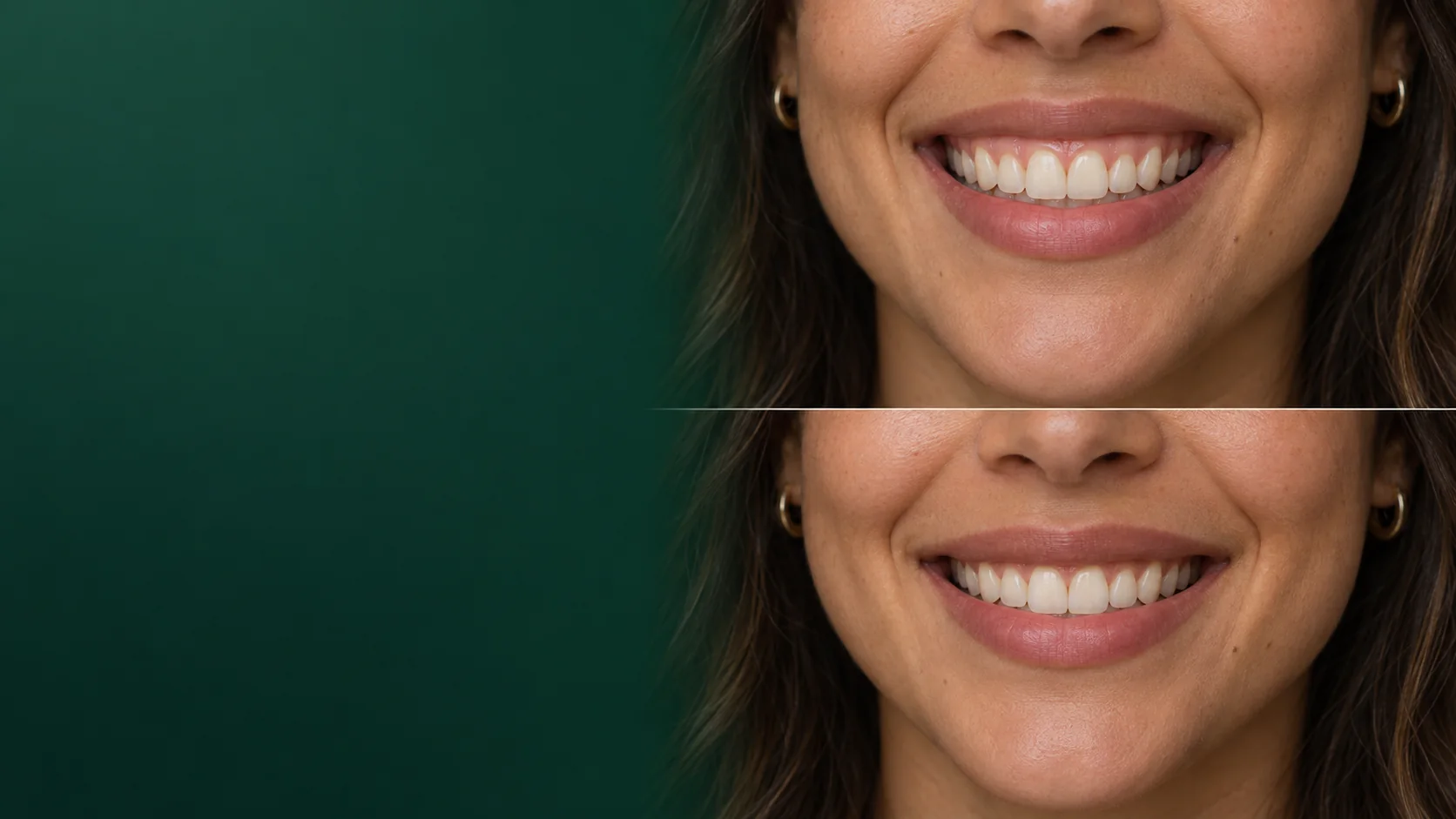 Dois recortes do mesmo sorriso com diferentes níveis de exposição da gengiva. Simulação ilustrativa; não representa resultado real.